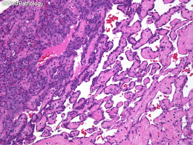 Primary Breast Angiosarcoma
