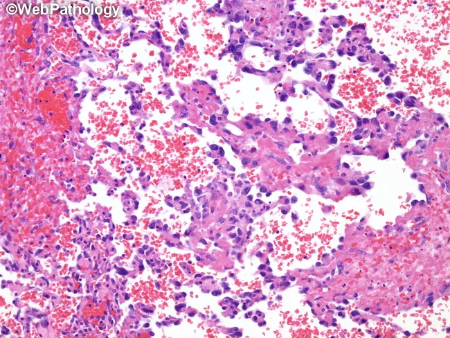 Cardiac Angiosarcoma : Differential
