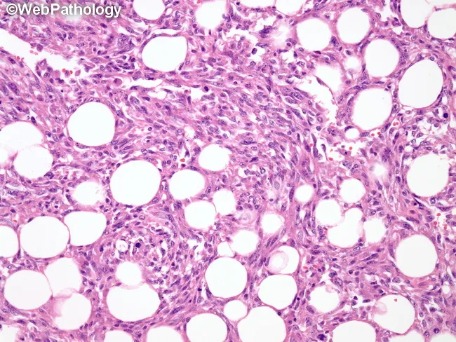 Cardiac Angiosarcoma
