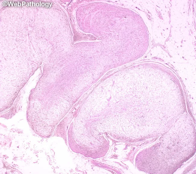 Plexiform Neurofibroma