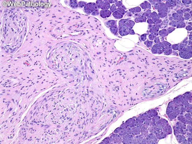 neurofibromatosis-1-plexiform-neurofibromas