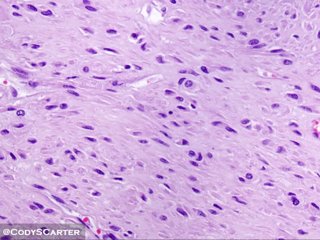 gist-in-nf1