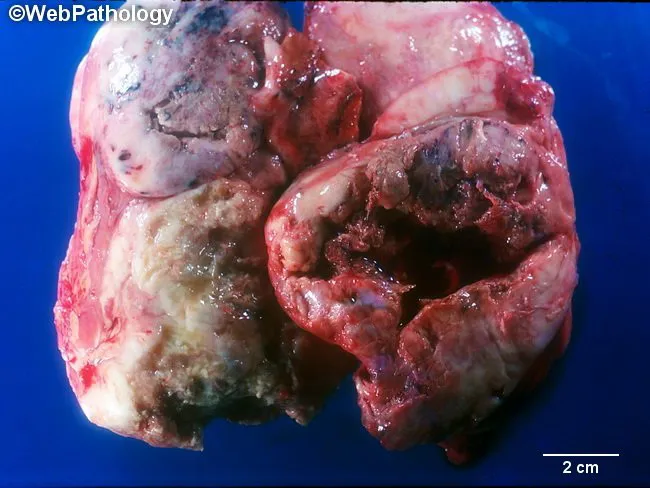 melanotic peripheral nerve sheath tumor Malignant melanotic nerve sheath tumor with PRKAR1A, KMT2C and GNAQ  mutations main image 0