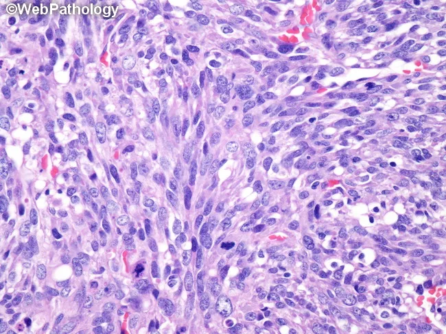 malignant melanotic nerve sheath tumor pathology outlines Malignant Triton Tumor
