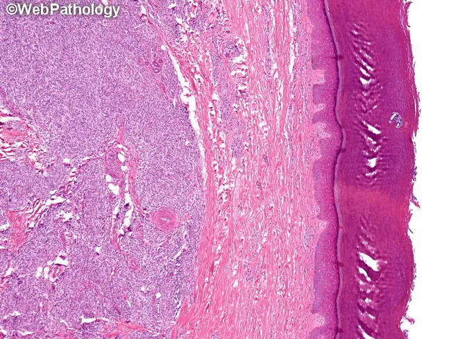 Clear Cell Sarcoma