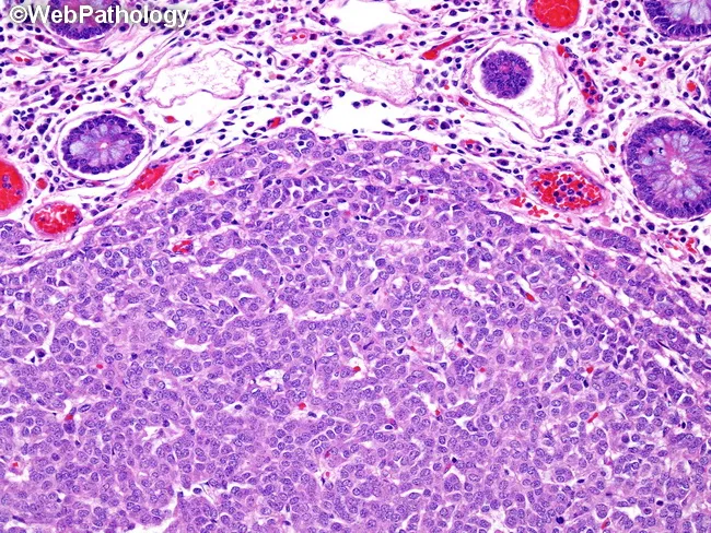 Clear Cell Sarcoma-like Tumor of GI Tract