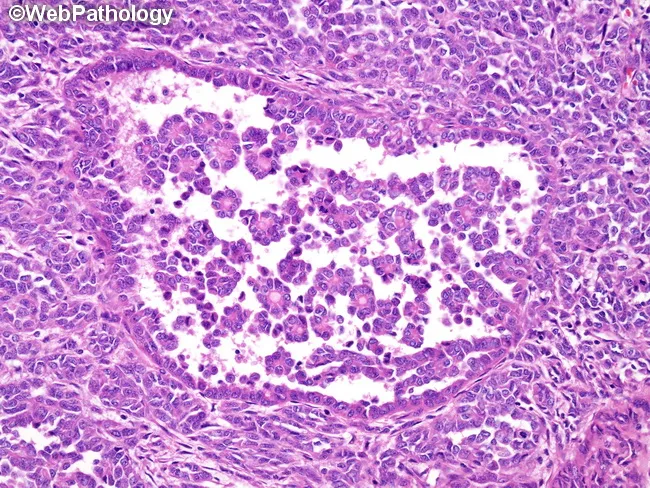Clear Cell Sarcoma-like Tumor of GI Tract