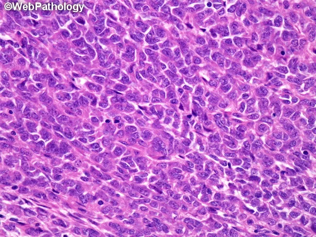 Clear Cell Sarcoma-like Tumor of GI Tract