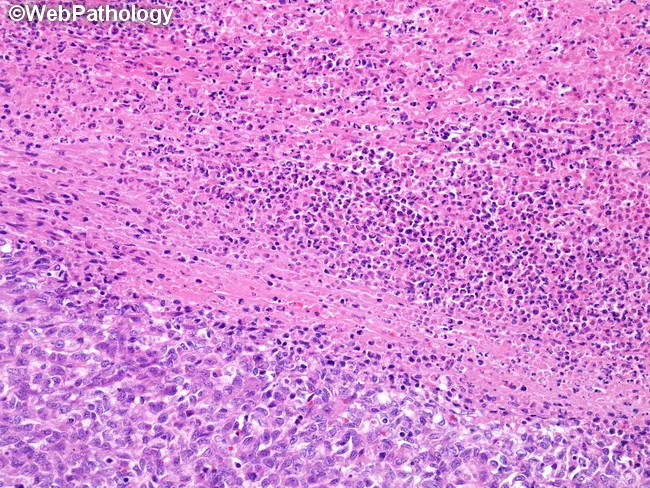 Clear Cell Sarcoma-like Tumor of GI Tract