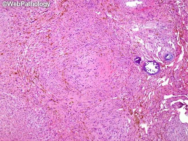 malignant psammomatous melanotic schwannoma Psammomatous Melanotic Schwannoma