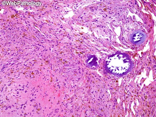 Psammomatous Melanotic Schwannoma