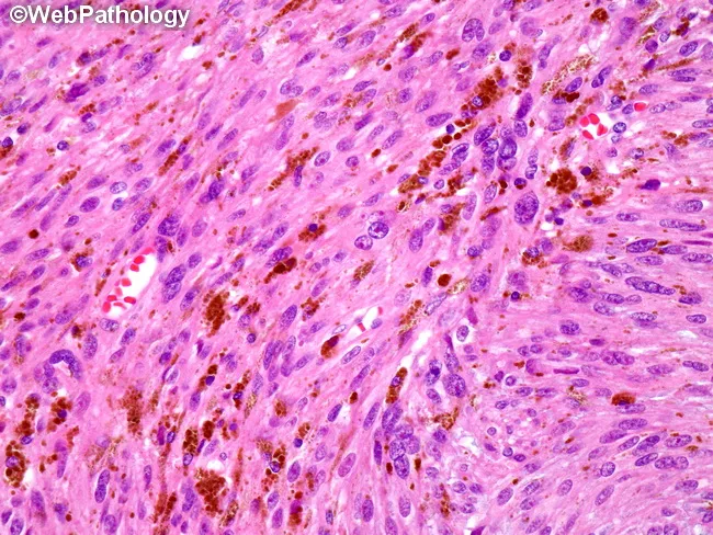 metastatic melanotic schwannoma Psammomatous Melanotic Schwannoma
