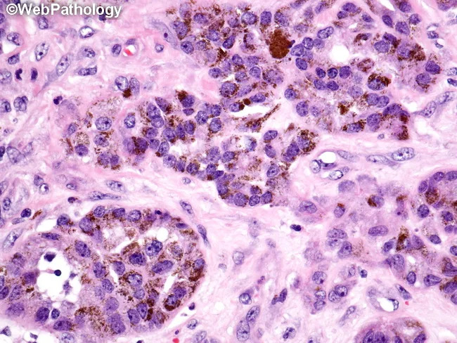 Melanotic Neuroectodermal Tumor of Infancy