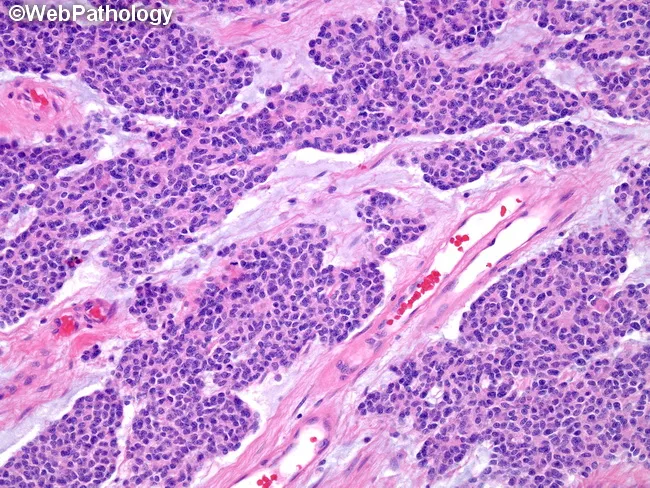 Desmoplastic Small Round Cell Tumor
