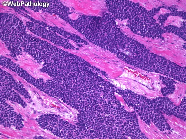 Desmoplastic Small Round Cell Tumor