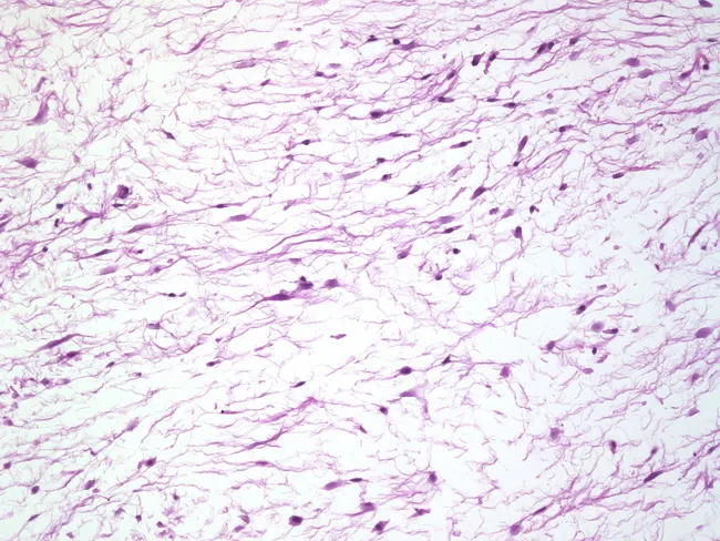 Intramuscular Myxoma