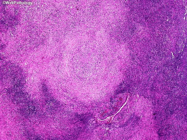 Granulomatosis with Polyangiitis (Wegener's)