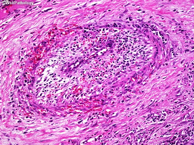 Granulomatosis with Polyangiitis (Wegener's)