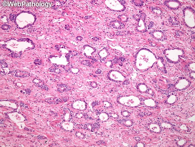 Acinar Adenocarcinoma