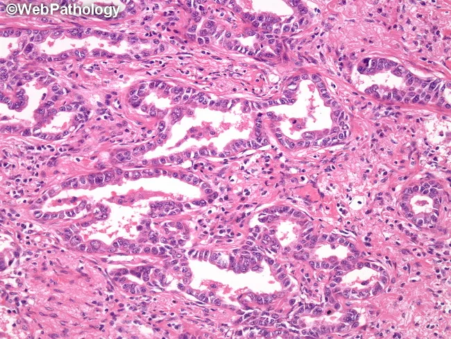 Acinar Adenocarcinoma 訳 | Kyoto University Research Information ...