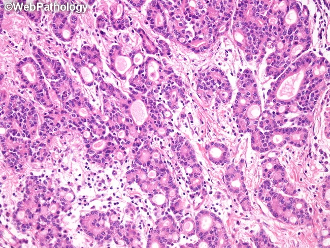 Acinar Adenocarcinoma