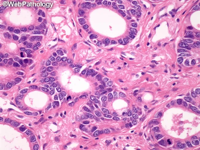 Acinar Adenocarcinoma