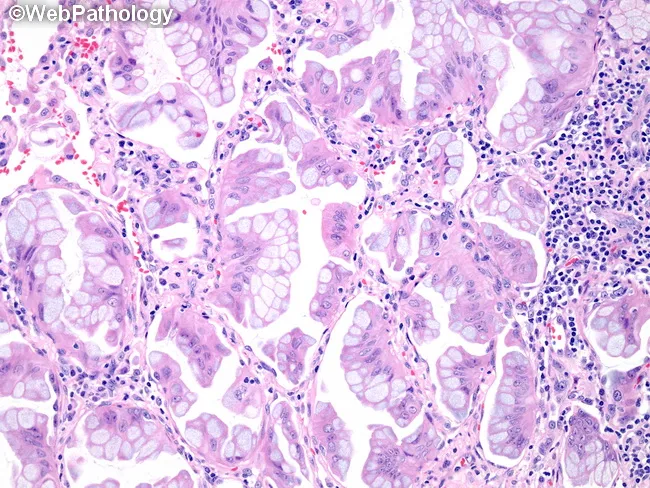 Invasive Mucinous Adenocarcinoma
