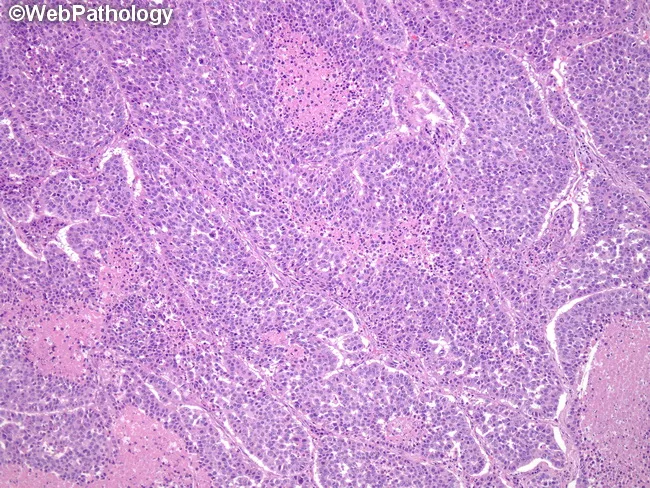 Large Cell NE Carcinoma