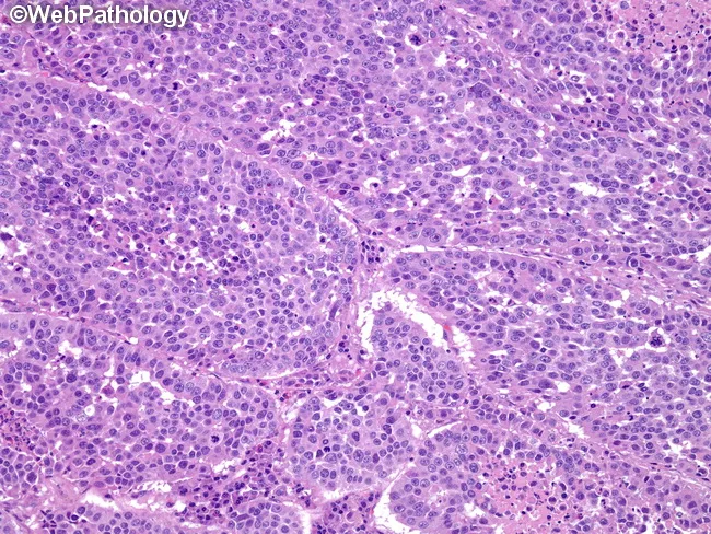 Large Cell NE Carcinoma