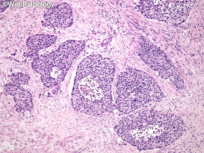 Large Cell NE Carcinoma