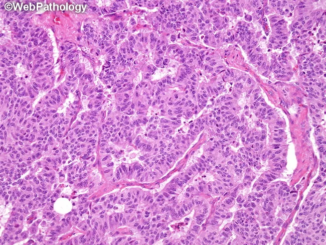 Carcinoid : Trabecular Pattern