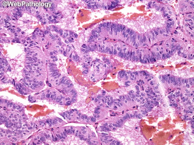 Carcinoid : Papillary Pattern