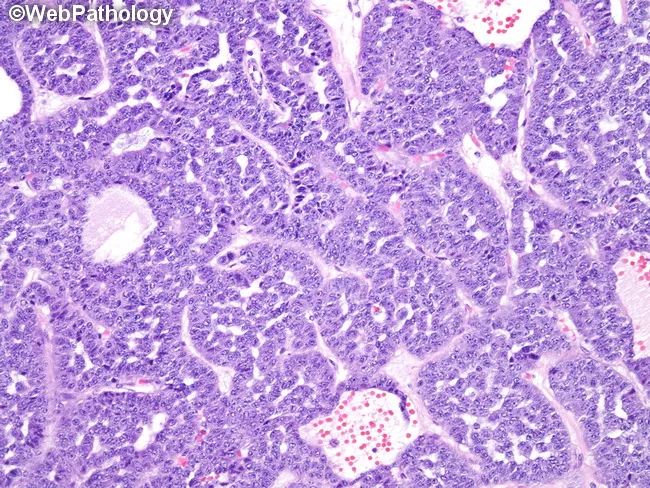 Carcinoid : Pseudoglandular Pattern