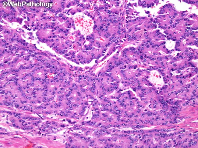 Carcinoid : Rosettes