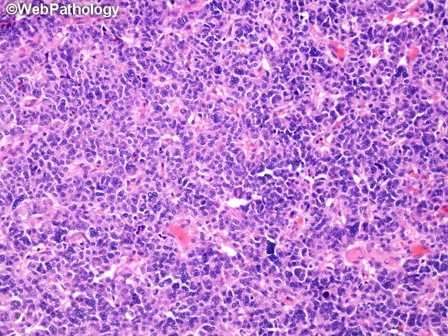 Carcinoid : Rosettes