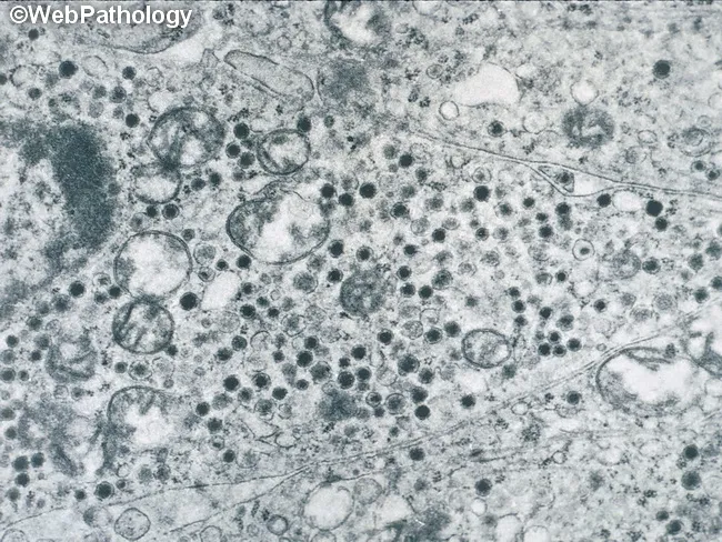 glutathione neuroendocrine pathology and neurodegenerative diseases: immunopharmacological implications Carcinoid : Electron Microscopy