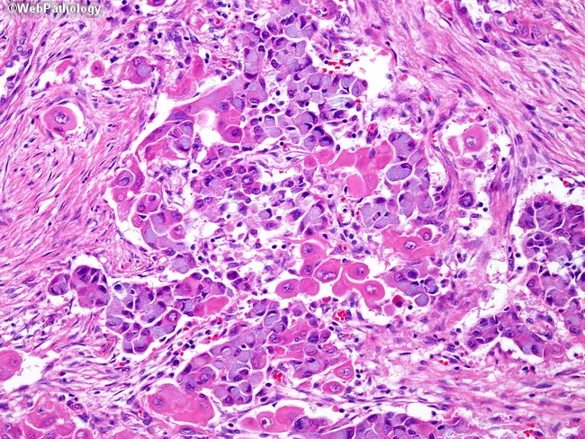 Adenosquamous Carcinoma