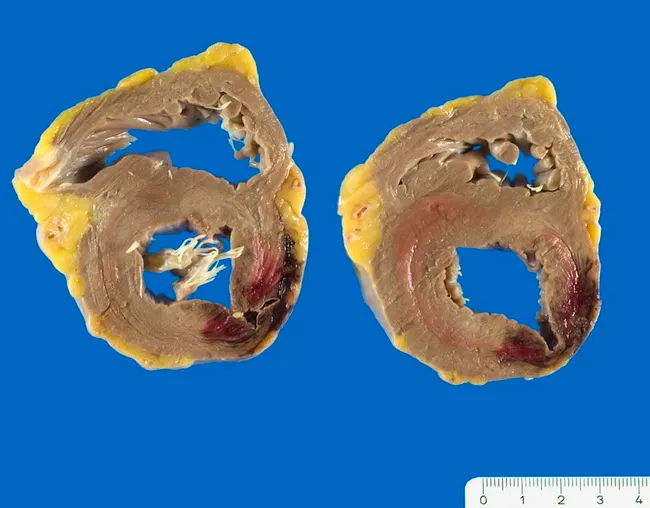 Myocardial Infarction - Rupture of Free Wall