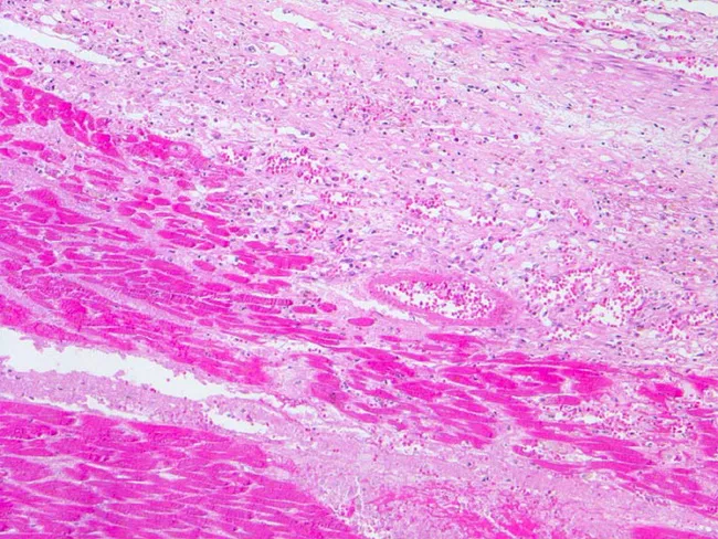Myocardial Infarction Histology Slide