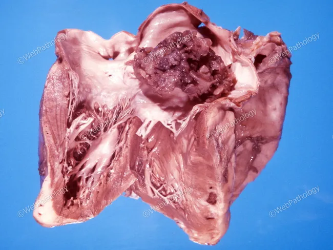 Cardiac Myxoma : Introduction