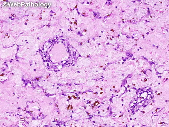 Cardiac Myxoma : Microscopic Features