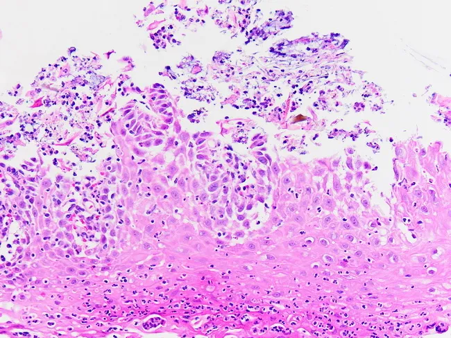 Candida Esophagitis