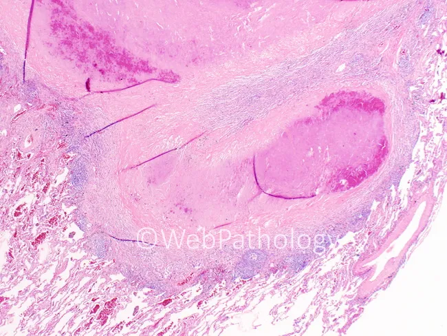 Pulmonary Coccidioidomycosis: Clinical Features