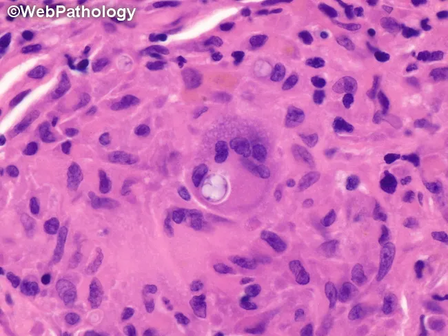 Pulmonary Coccidioidomycosis