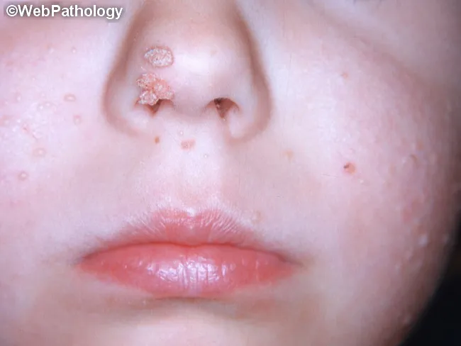HPV Pathogenicity