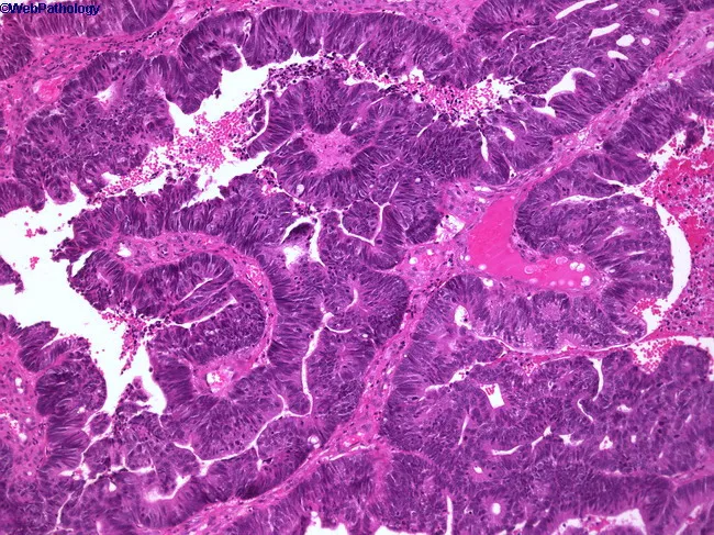 Sinonasal Adenocarcinoma - Intestinal Type