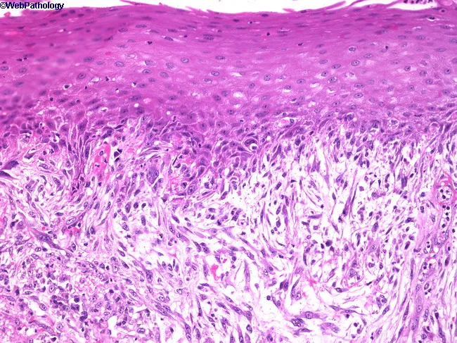 Sarcomatoid Squamous Cell Carcinoma
