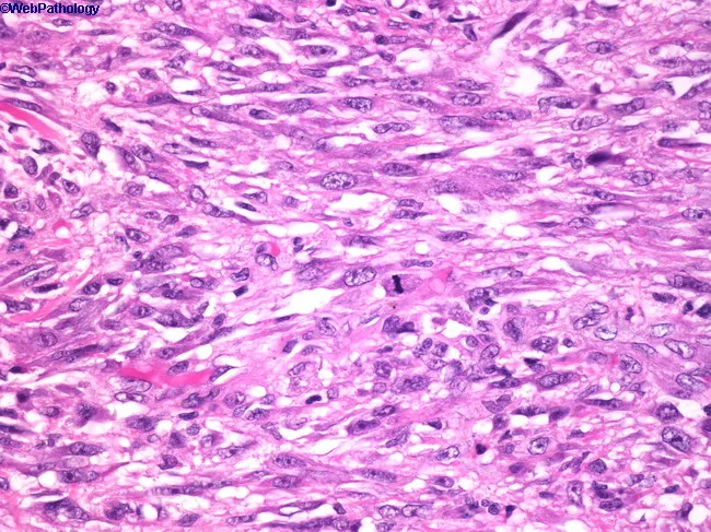 Sarcomatoid Squamous Cell Carcinoma