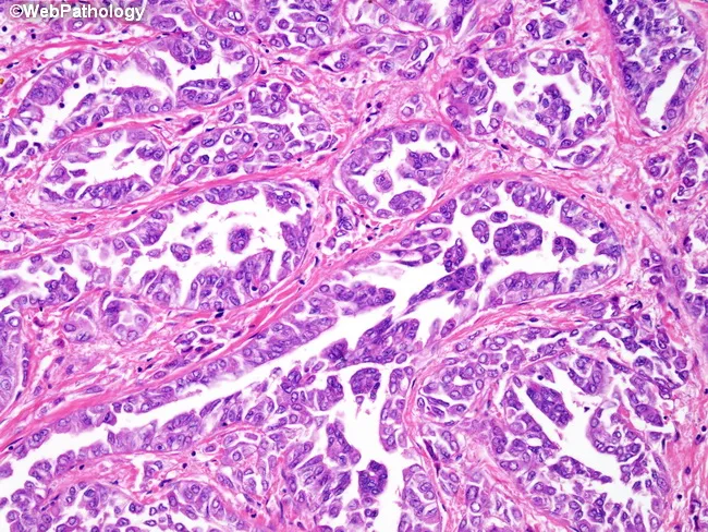 Malignant Mesothelioma : Acinar pattern