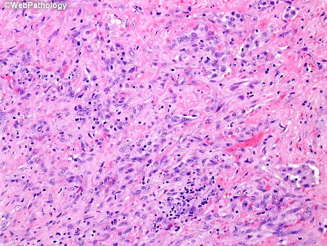 Desmoplastic Mesothelioma